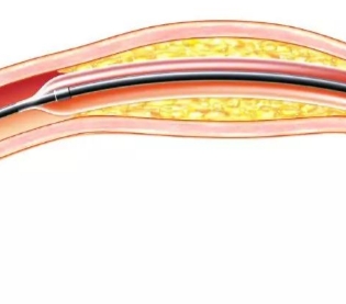 冠狀動(dòng)脈球囊擴(kuò)張導(dǎo)管