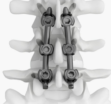 脊柱后路內(nèi)固定系統(tǒng)貝思達(dá)