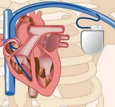 MC1AVR1 美敦力經(jīng)導(dǎo)管植入式無導(dǎo)線起搏系統(tǒng)